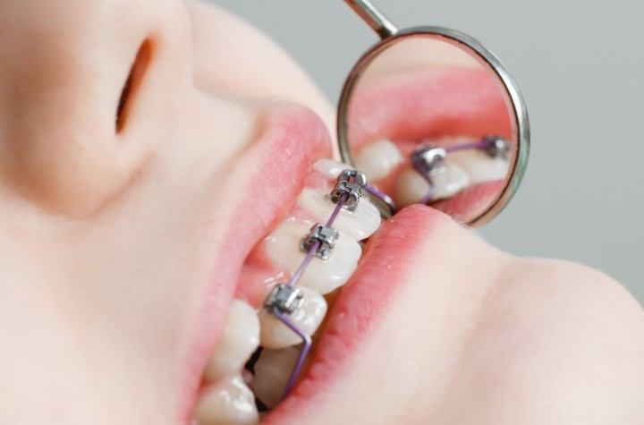 Брекеты – это металлические или керамические конструкции, крепящиеся на поверхности зубов. 