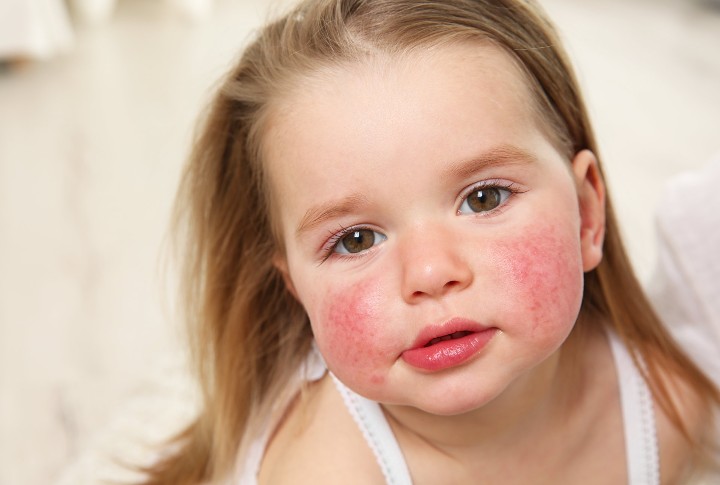 Главным фактором развития аллергии у детей является генетическая предрасположенность. 